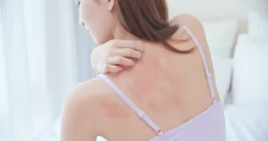 rashes on a woman's back