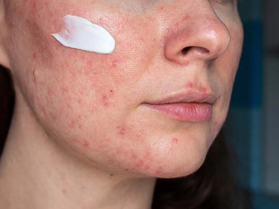 a woman applies topical medication on her skin with rosacea